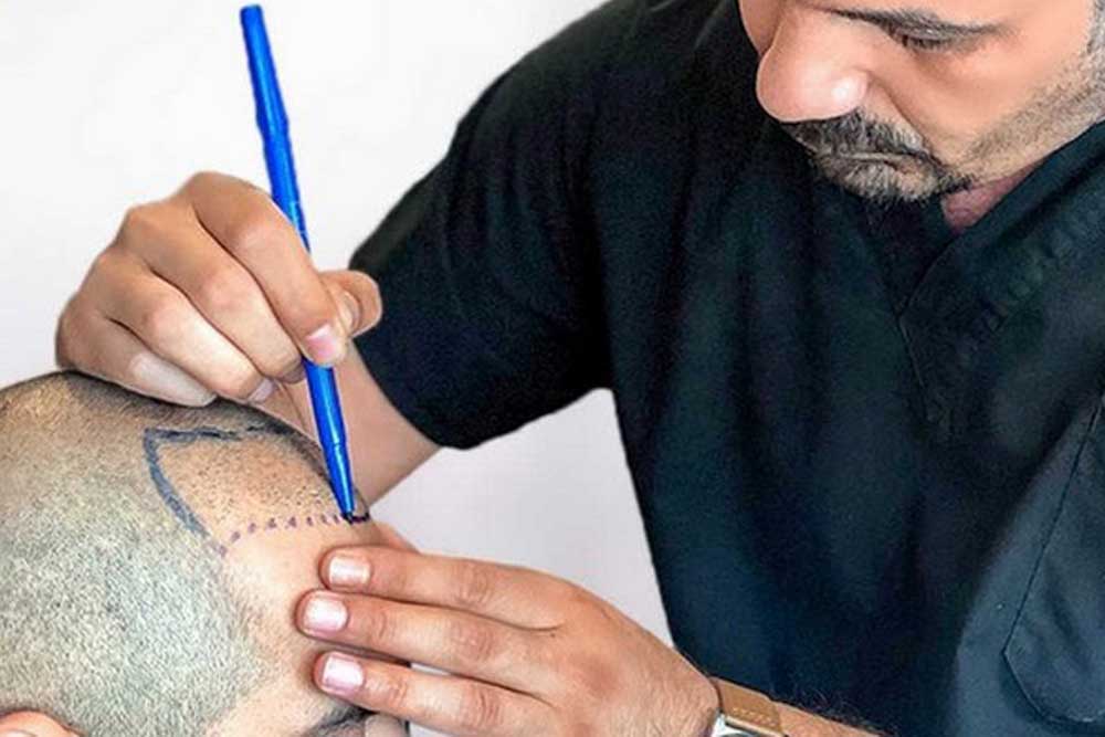 سایت کاشت مو